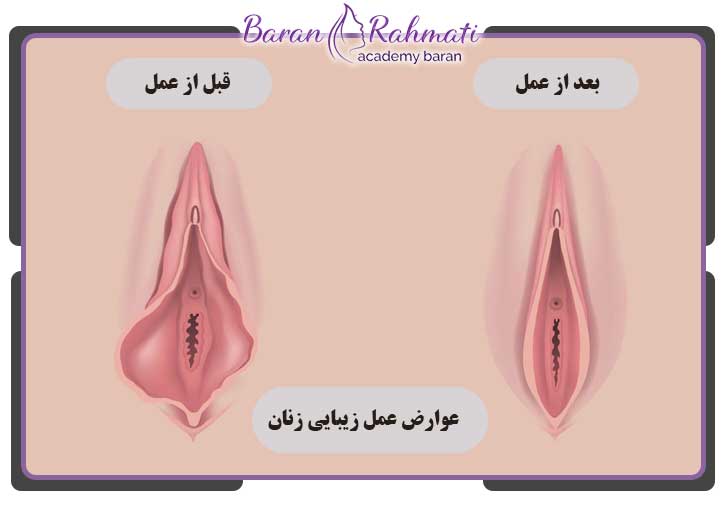 عوارض عمل لابیپلاستی