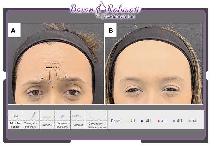 نقاط تزریق بوتاکس در گلابلا