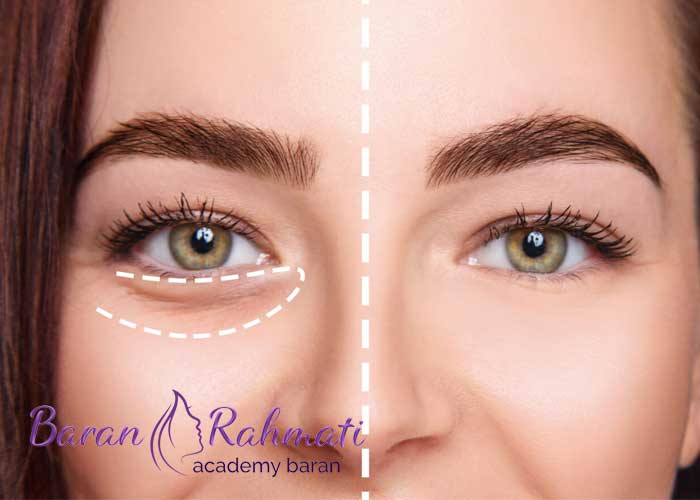 Read more about the article مهم ترین تفاوت مزوژل با فیلر زیر چشم که نمیدانید !