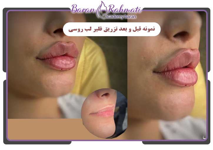نمونه تزریق فیلر لب اروپایی