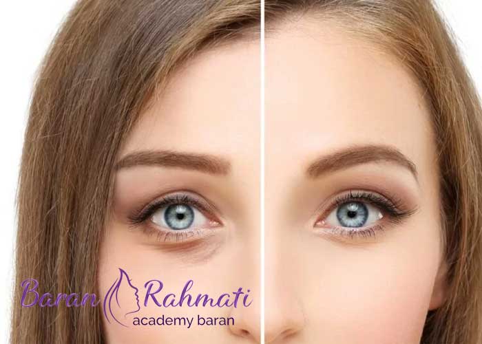 Read more about the article آموزش بلفاروپلاستی در تهران با مدرک معتبر (آموزش جراحی پلک در تهران)