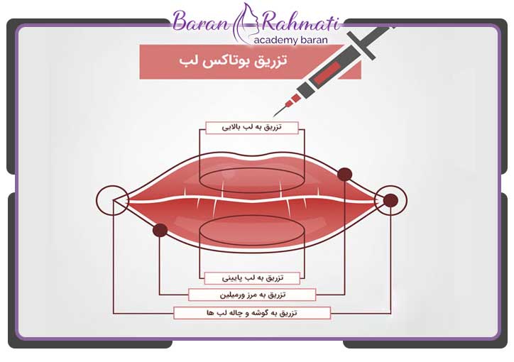 آموزش نقاط تزریق بوتاکس در لب