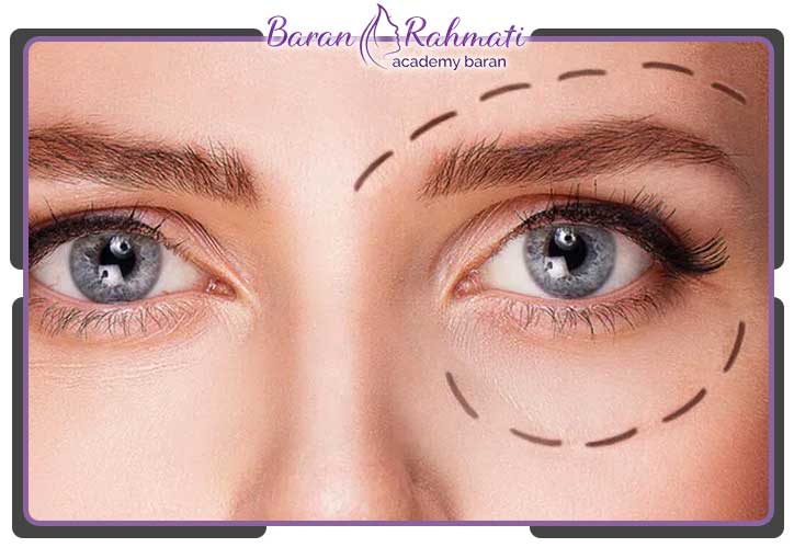 آموزش نقاط تزریق بوتاکس چشم گربه ای