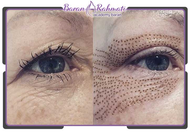 نقاط قابل درمان با پلکسر