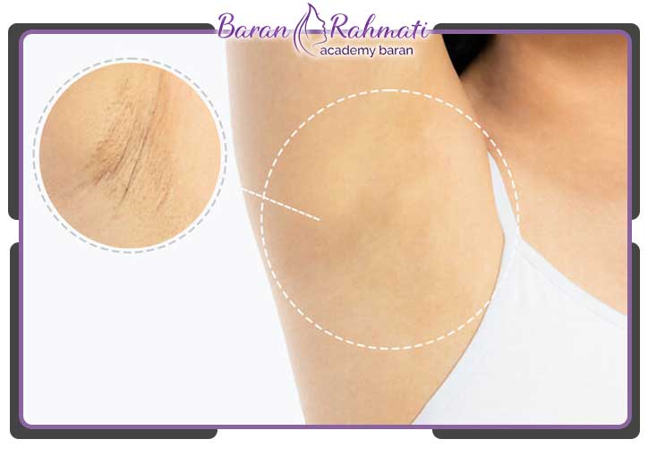 عکس قبل و بعد کربوکسی تراپی زیر بغل