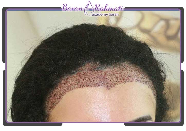 عوارض کاشت مو در زنان