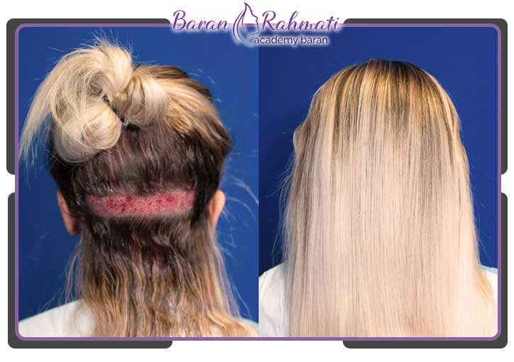 کاشت مو برای زنان امکان پذیر است ؟