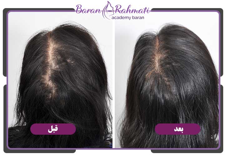 عکسهای کاشت موی زنان