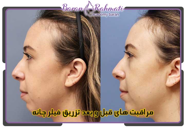 عکس فیلر چانه