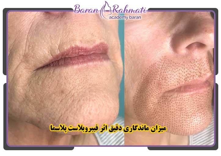 میزان ماندگاری دقیق اثر فیبروبلاست پلاسما