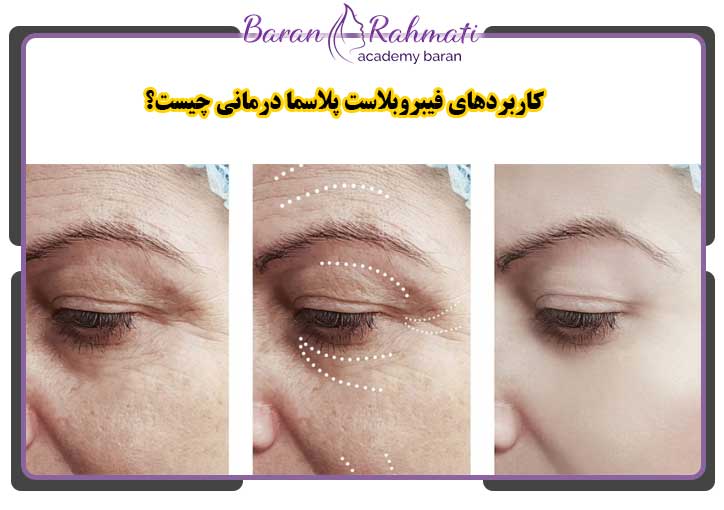 کاربردهای فیبروبلاست پلاسما درمانی چیست؟