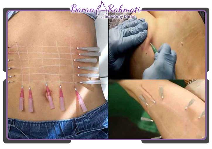 کاربردهای کاشت نخ لاغری در سنندج