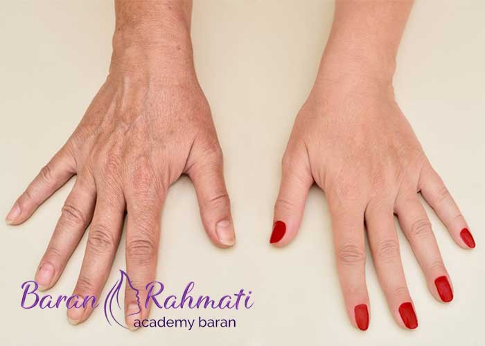 Read more about the article معرفی بهترین روش های جوانسازی پوست دست