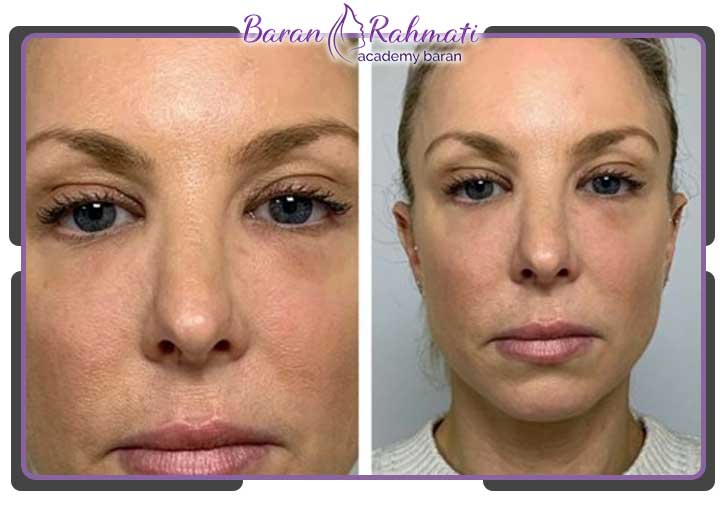 معایب نقاط تزریق ژل روی صورت‌های لاغر