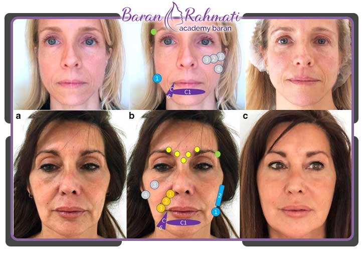 مزایای تزریق ژل به صورت ‌های لاغر