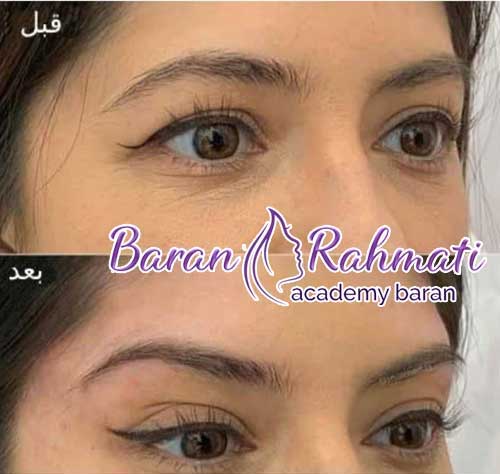 عکس بوتاکس چشم گربه ای