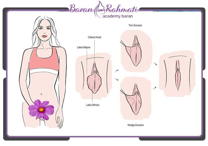 آموزش لابیاپلاستی در سنندج