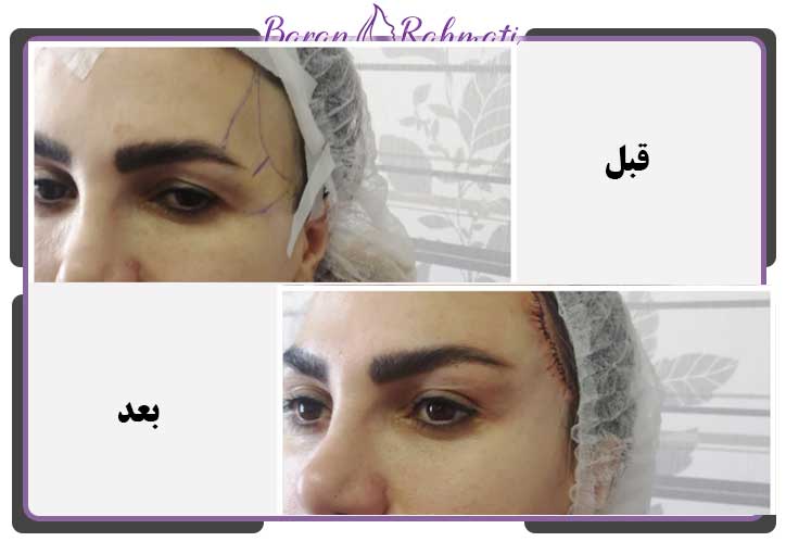 عکس قبل و بعد لیفت شقیقه