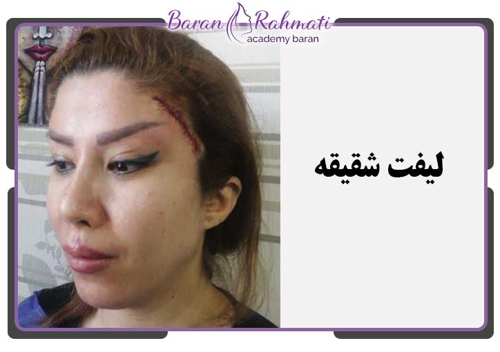 ـموزش لیفت شقیقه