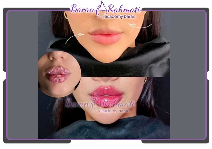 آموزش تزریق ژل و بوتاکس بوشهر