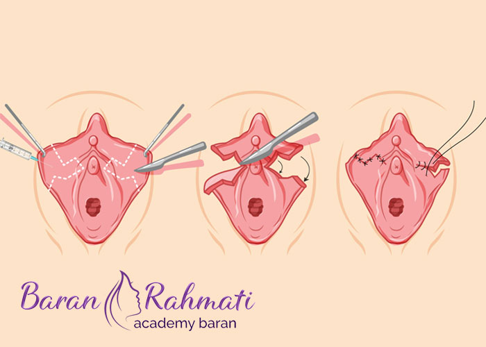 Read more about the article آموزش لابیاپلاستی در سنندج