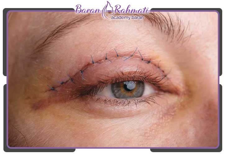 آموزش جراحی پلک در کرج