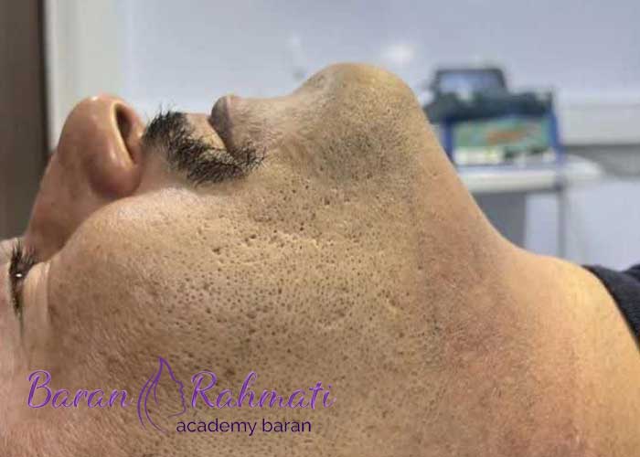 Read more about the article آموزش تخلیه چربی غبغب مشهد