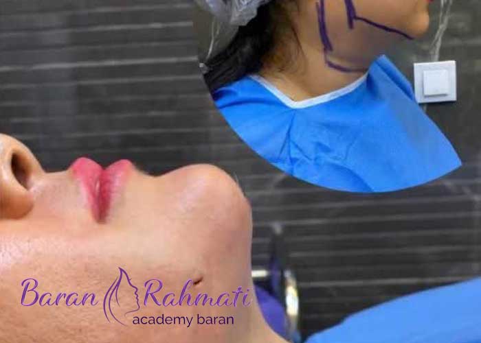 Read more about the article آیا ساکشن غبغب برگشت پذیر است؟