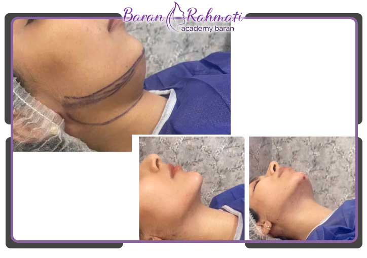 ساکشن غبغب وجود دارد؟