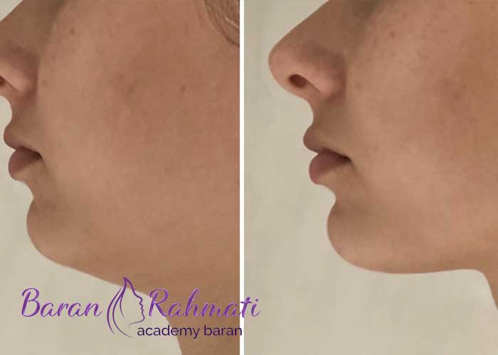 Read more about the article آموزش لیپوساکشن غبغب در تهران