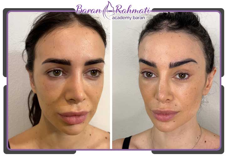 آموزش جراحی لیفت شقیقه