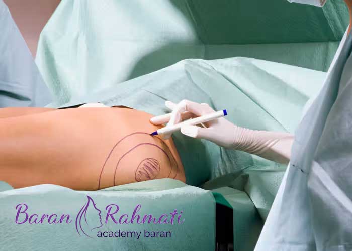 Read more about the article آموزش تخلیه چربی در تهران