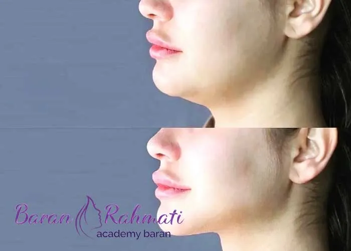 Read more about the article آموزش لیپوساکشن غبغب در شیراز