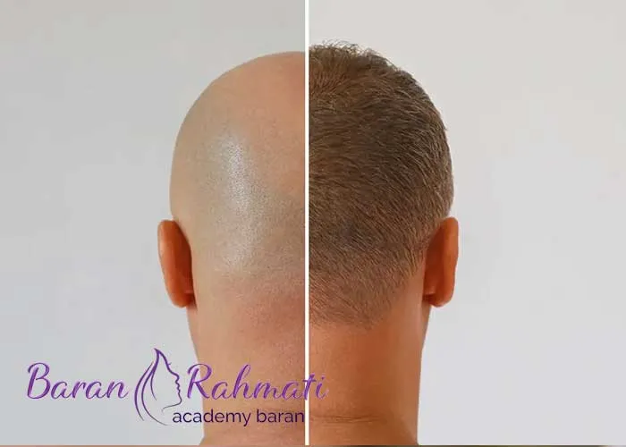 Read more about the article آموزش کاشت مو در قم