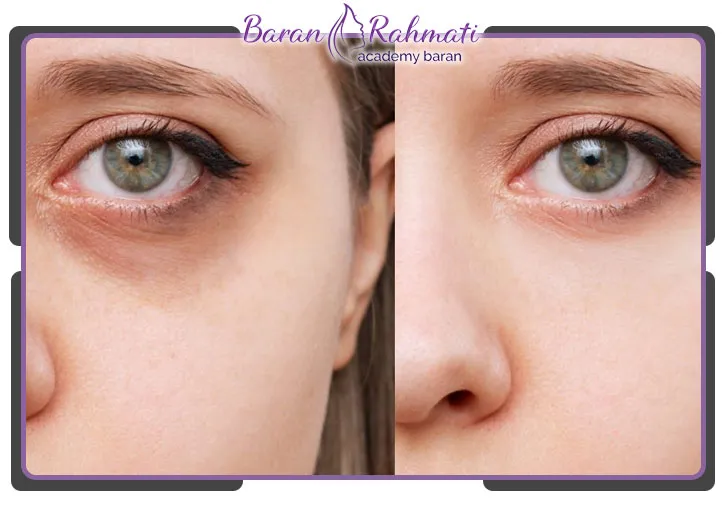 بهترین مرکز تزریق مزوژل در تبریز برای آموزش مزوژل در تبریز