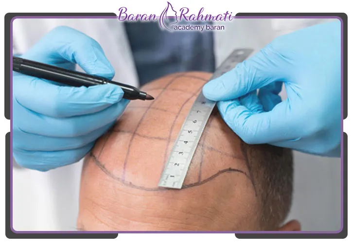 دوره یادگیری کاشت مو و ابرو در قم