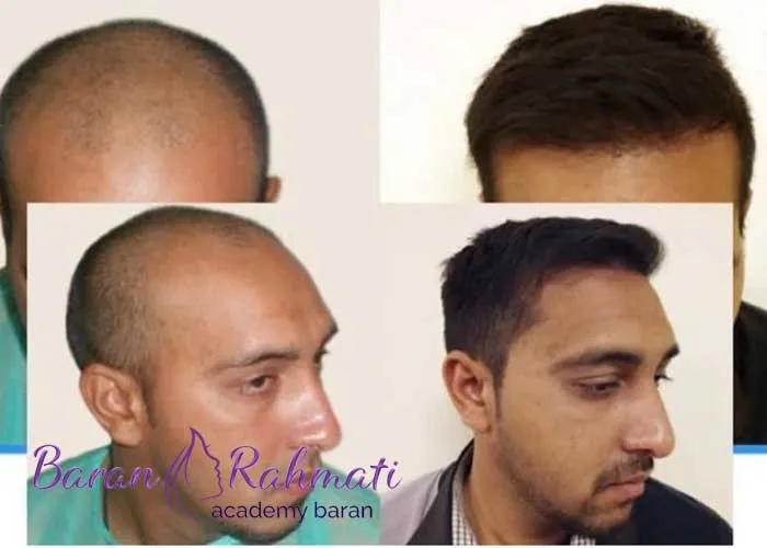 Read more about the article آموزش کاشت مو و ابرو در کرج