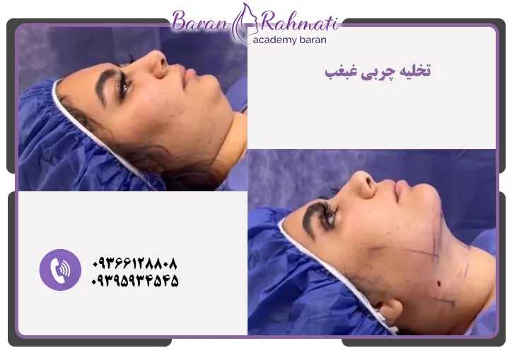 آموزش تخلیه چربی غبغب در کرج
