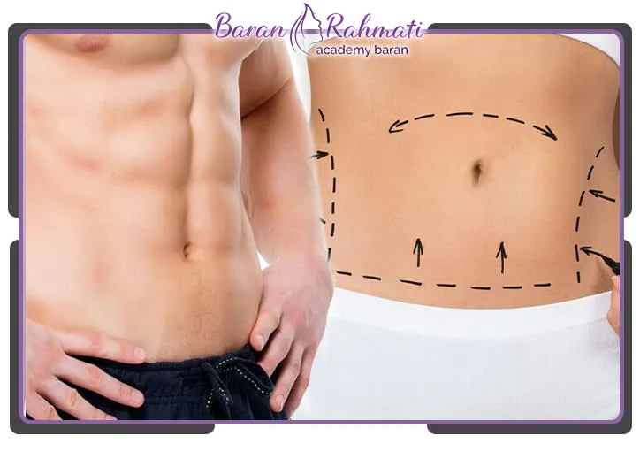 انواع روش‌ های ابدومینوپلاستی