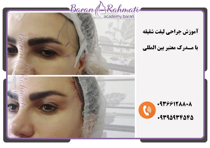 بهترین آموزشگاه آموزش لیفت شقیقه در اصفهان