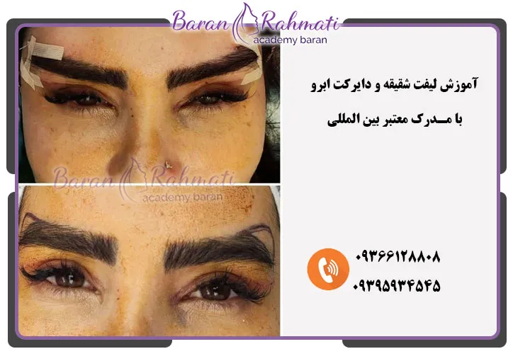 لیفت شقیقه و دایرکت ابرو 