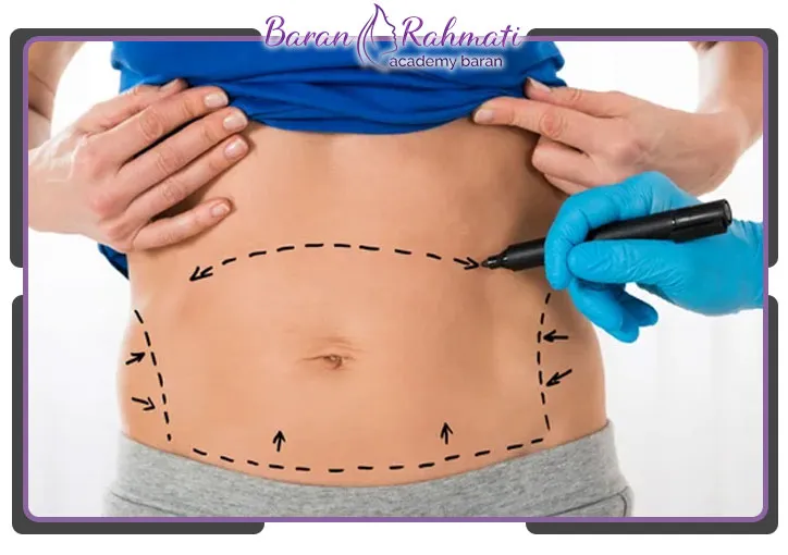 مزایای ابدومینوپلاستی