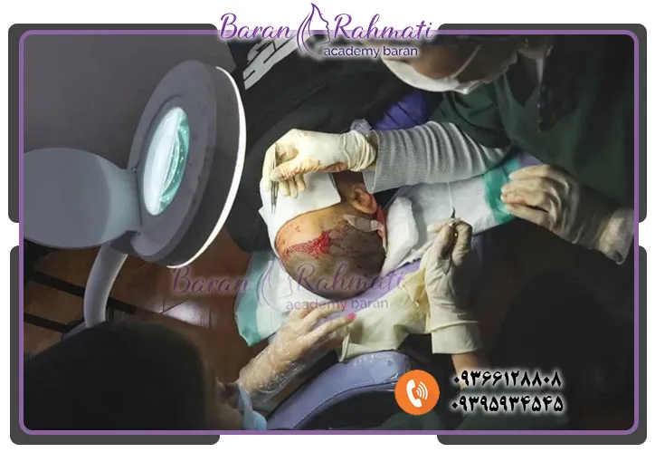 هزینه آموزش کاشت مو در کرمانشاه