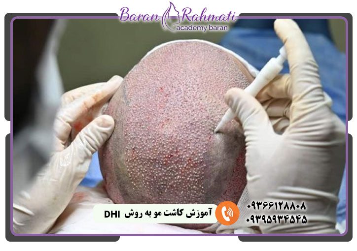 آموزش کاشت مو به روش DHI 