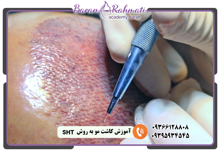 آموزش کاشت مو به روش SHT