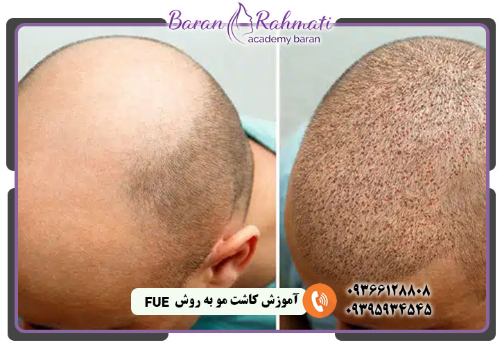 آموزش کاشت مو به روش fue