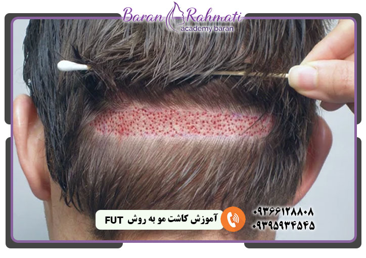 آموزش کاشت مو به روش fut