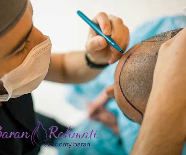 آموزش کاشت مو و ریش و ابرو در ارومیه