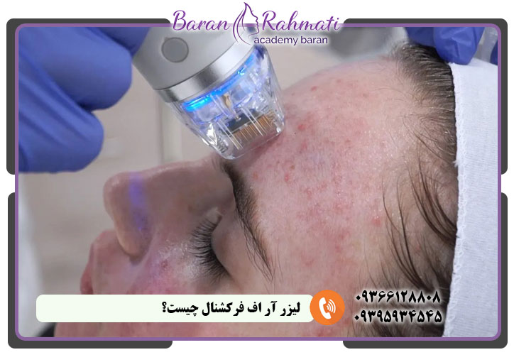 لیزر آر اف فرکشنال چیست؟