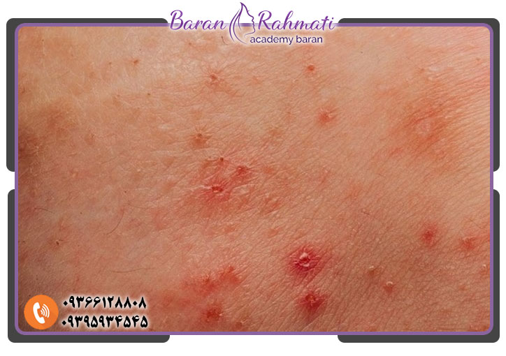 ممنوعیت لیزر برای پوست حساس